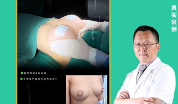 张敬德2026年脂肪胸案例02